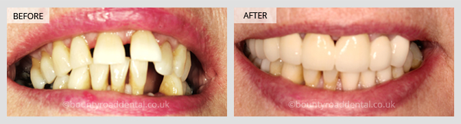 Smile Makeover / Implant & Bridge