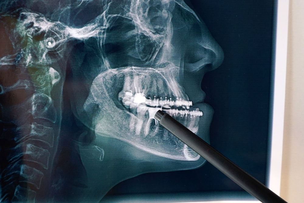 Dental CT Scans