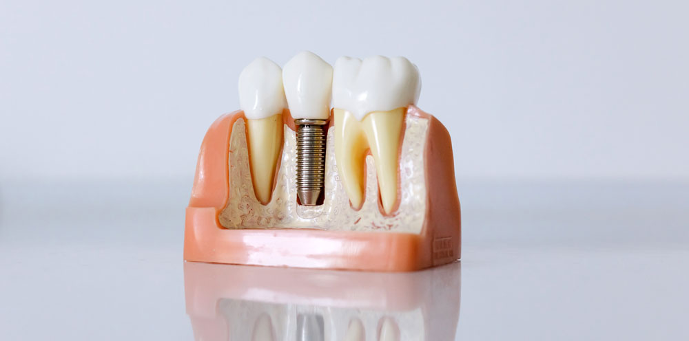 Dental Implants