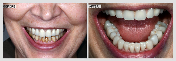 Full mouth reconstruction with implant bridges and crowns